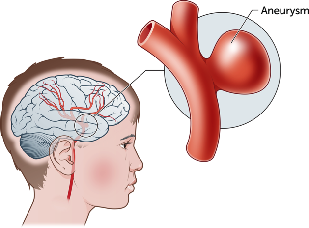 1-Aneurisma -