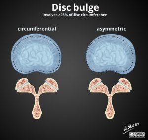 Abaulamento discal