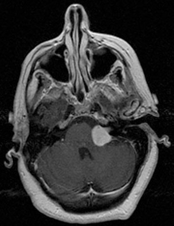 Schwannoma
