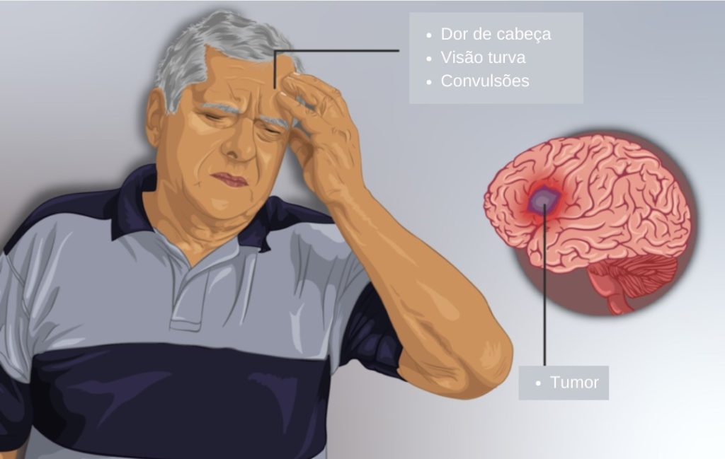 Tumores intracranianos