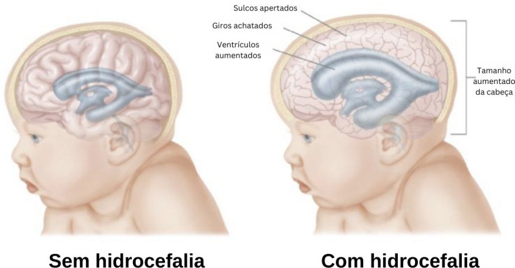 Hidrocefalia