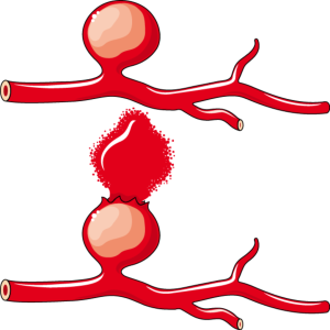 Aneurisma Sacular