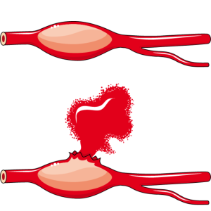 Aneurisma fusiforme