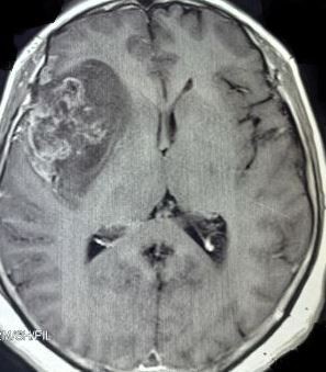 Glioblastoma Multiforme