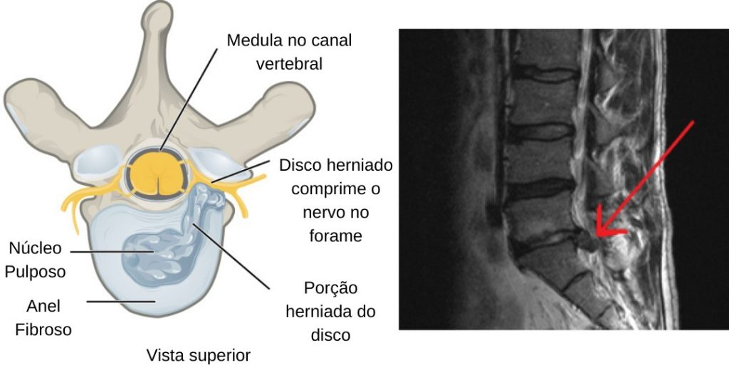 Hérnia de disco