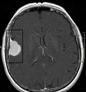 Detalhes do anexoSalvo. Meningioma.jpg 14 de novembro de 2024 56 KB 640 por 688 píxeis Editar imagem Excluir permanentemente Texto alternativo Descreva a finalidade da imagem(abrir em uma nova aba). Deixe em branco se a imagem é apenas decorativa.