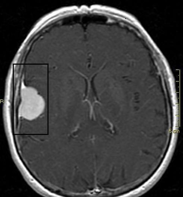 Detalhes do anexoSalvo. Meningioma.jpg 14 de novembro de 2024 56 KB 640 por 688 píxeis Editar imagem Excluir permanentemente Texto alternativo Descreva a finalidade da imagem(abrir em uma nova aba). Deixe em branco se a imagem é apenas decorativa.