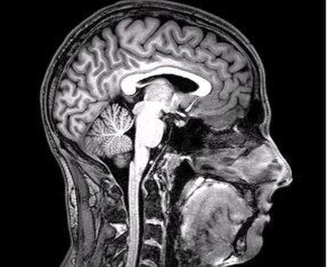 Ressonância Magnética de tumor hipofisiário