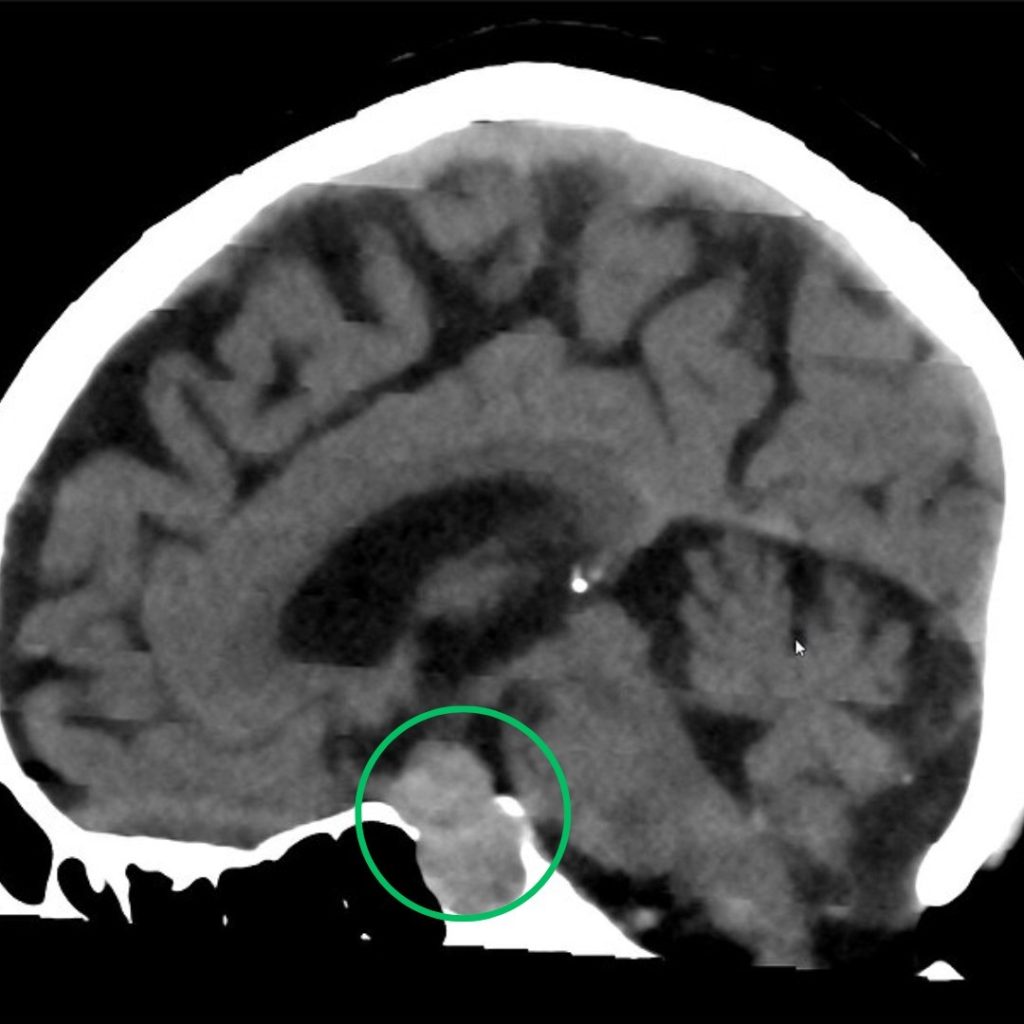 Tomografia Computadorizada de tumor hipofisiário