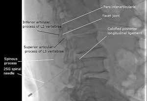 Imagem de fluoroscopia (Raio-X), na qual é possível visualizar a agulha indo de encontro ao canal medular guiada pela imagem.Retirado de: https://upload.wikimedia.org/wikipedia/commons/5/57/Fluoroscopy_guided_lumbar_puncture.j pg